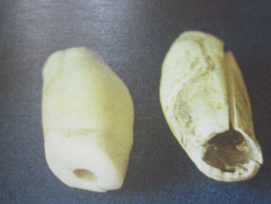 Orca-Zahn mit Karies-Befall (Foto: Günther Behrmann)